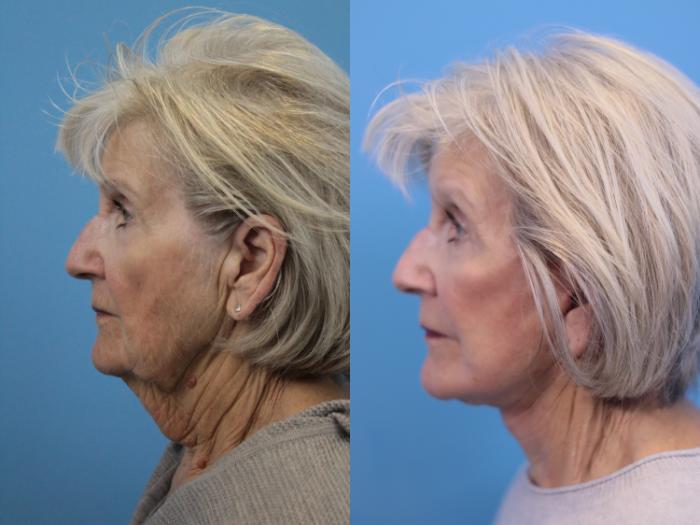 Before & After Facelift Case 308 Left Side View in West Des Moines & Ames, IA