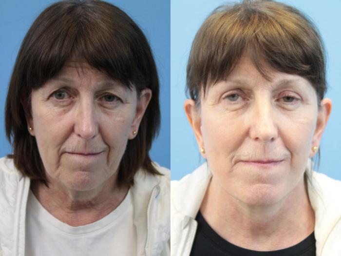 Before & After Blepharoplasty (Upper Eyelid Lift) Case 311 Front View in West Des Moines & Ames, IA