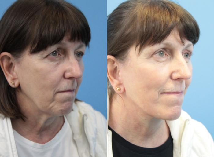 Before & After Blepharoplasty (Upper Eyelid Lift) Case 311 Right Oblique View in West Des Moines & Ames, IA