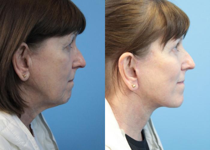 Before & After Blepharoplasty (Upper Eyelid Lift) Case 311 Right Side View in West Des Moines & Ames, IA