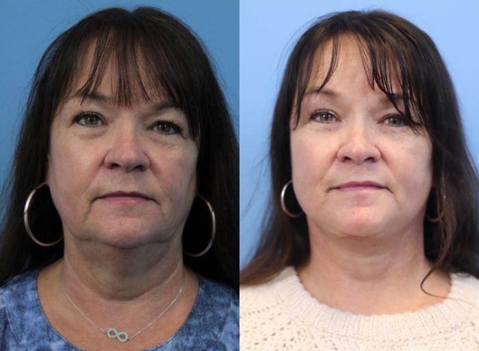 Before & After Facelift Case 313 Front View in West Des Moines & Ames, IA