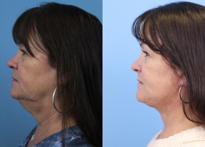 Before & After Facial Liposuction Case 313 Left Side View in West Des Moines & Ames, IA