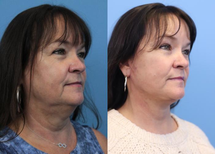 Before & After Facelift Case 313 Right Oblique View in West Des Moines & Ames, IA