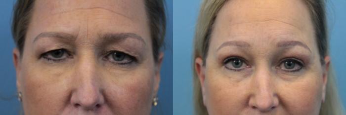 Before & After Blepharoplasty (Upper Eyelid Lift) Case 320 Front eyes View in West Des Moines & Ames, IA