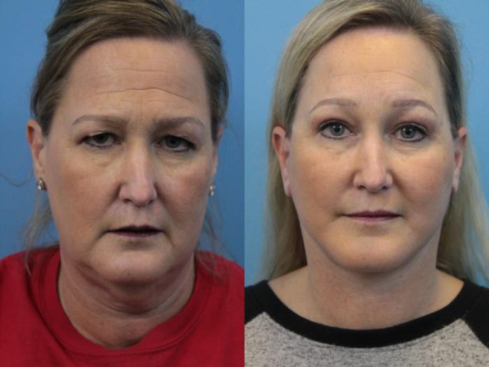 Before & After Blepharoplasty (Upper Eyelid Lift) Case 320 Front View in West Des Moines & Ames, IA