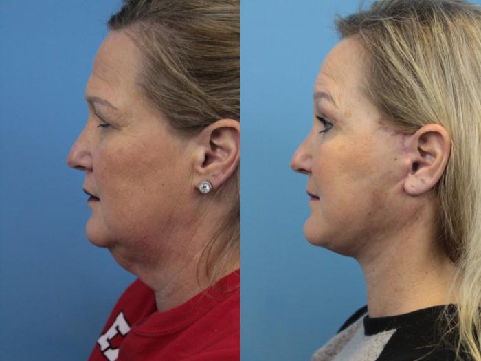 Before & After Facelift Case 320 Left Side View in West Des Moines & Ames, IA