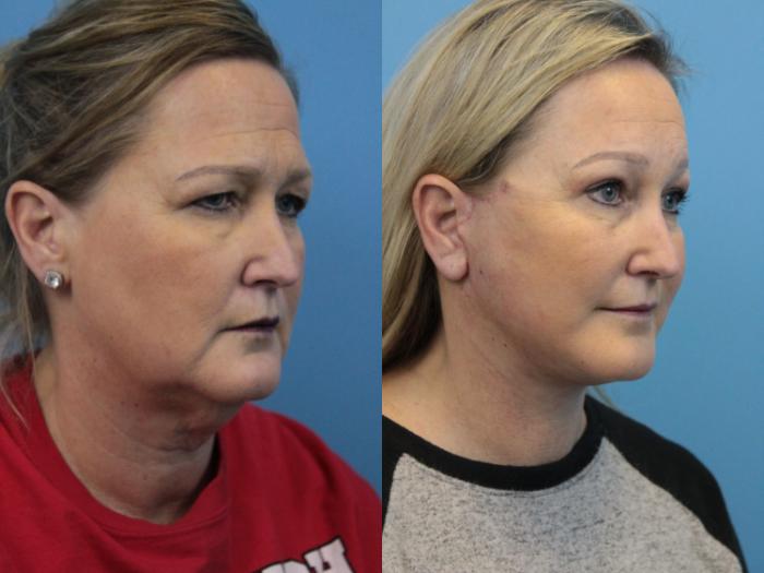 Before & After Blepharoplasty (Upper Eyelid Lift) Case 320 Right Oblique View in West Des Moines & Ames, IA