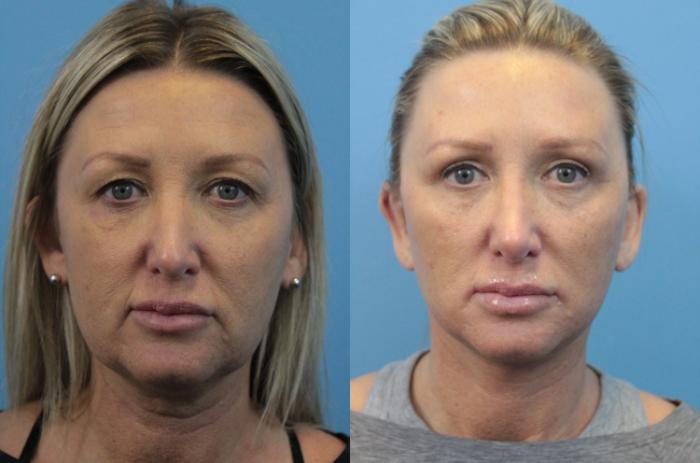 Before & After Facelift Case 322 Front View in West Des Moines & Ames, IA