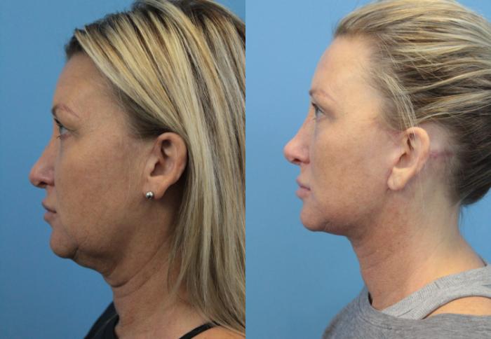 Before & After Ear Surgery Case 322 Left Side View in West Des Moines & Ames, IA