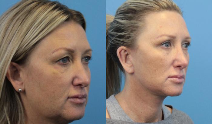 Before & After Facelift Case 322 Right Oblique View in West Des Moines & Ames, IA