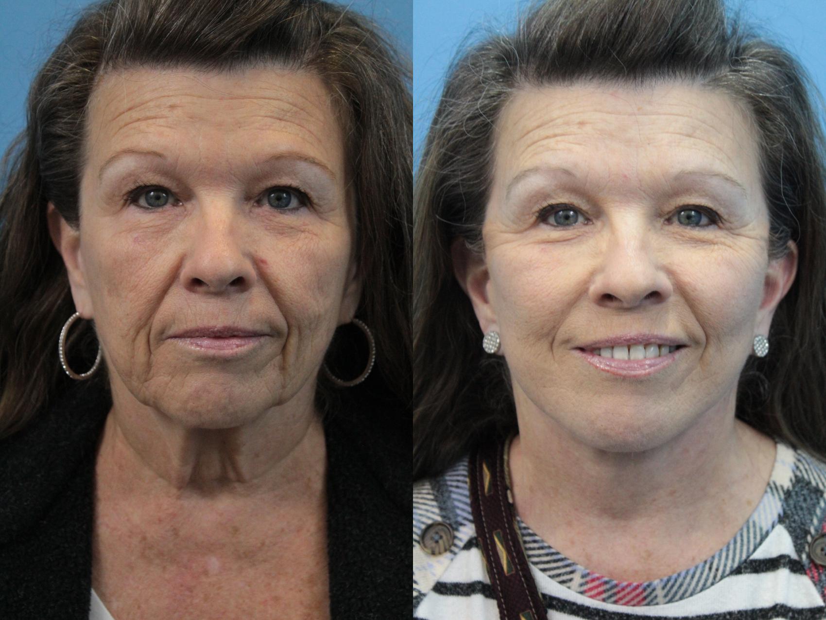 Before & After Facial Liposuction Case 329 Front View in West Des Moines & Ames, IA