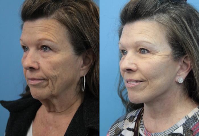 Before & After Facial Liposuction Case 329 Left Oblique View in West Des Moines & Ames, IA