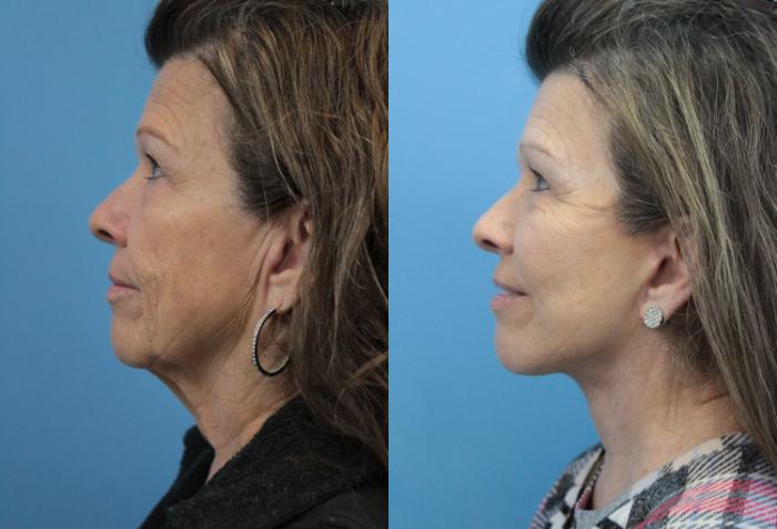 Before & After Facial Liposuction Case 329 Left Side View in West Des Moines & Ames, IA