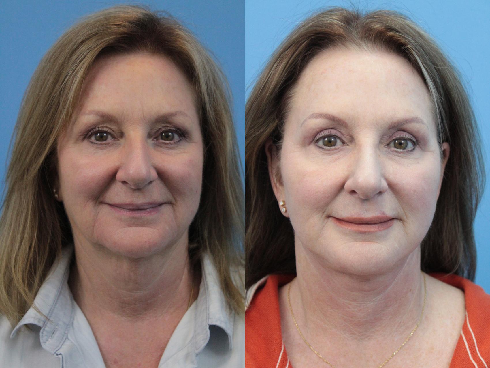 Before & After Blepharoplasty (Upper Eyelid Lift) Case 331 Front View in West Des Moines & Ames, IA