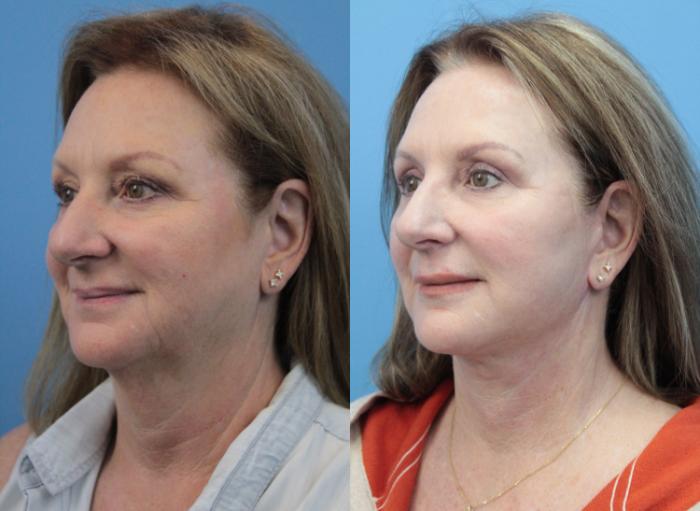 Before & After Facial Liposuction Case 331 Left Oblique View in West Des Moines & Ames, IA