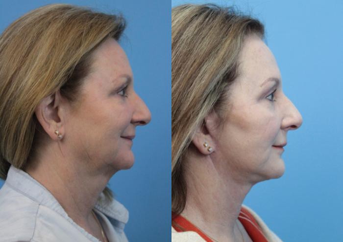 Before & After Facial Liposuction Case 331 Right Side View in West Des Moines & Ames, IA