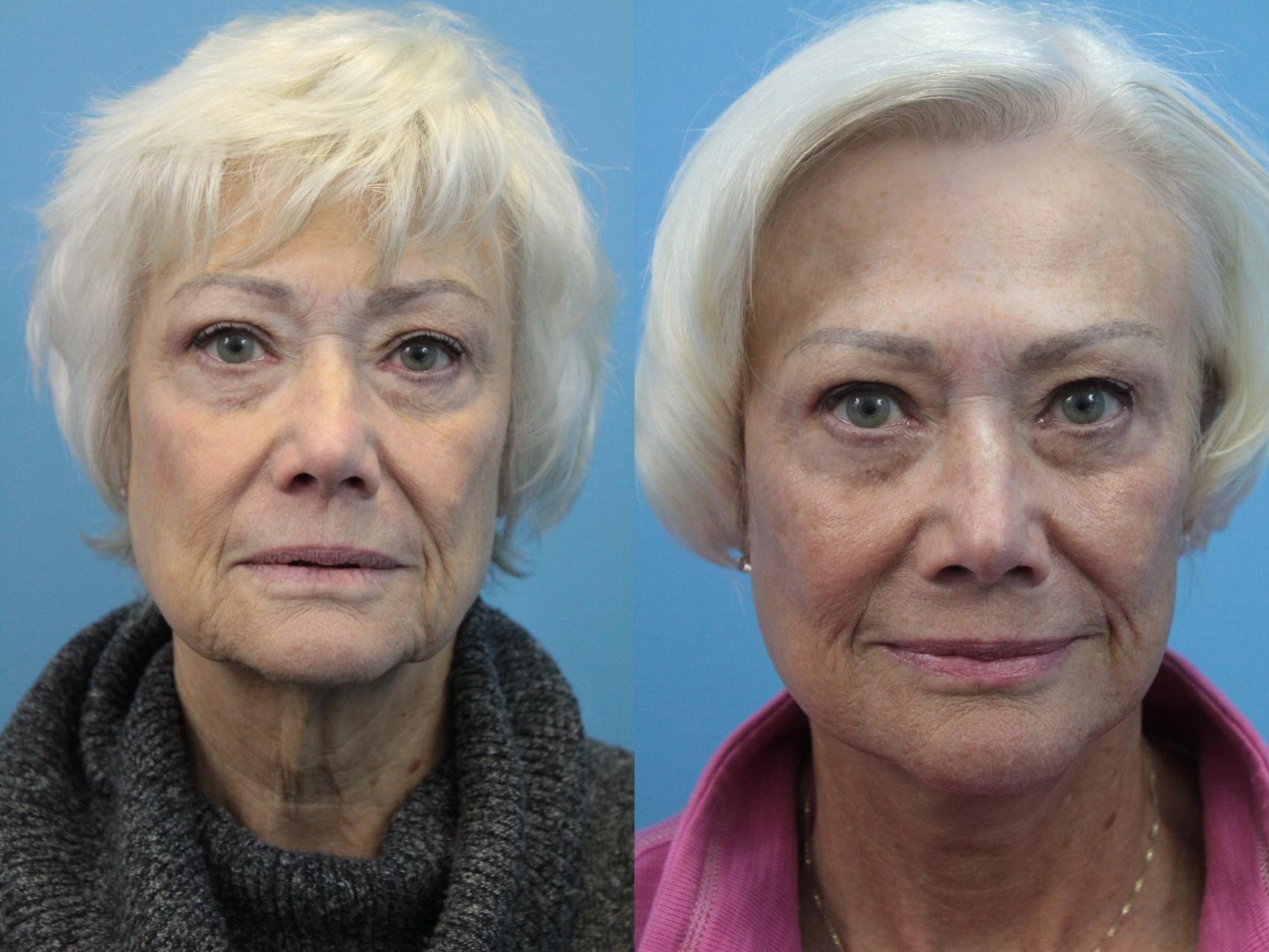 Before & After Facelift Case 339 Front View in West Des Moines, IA