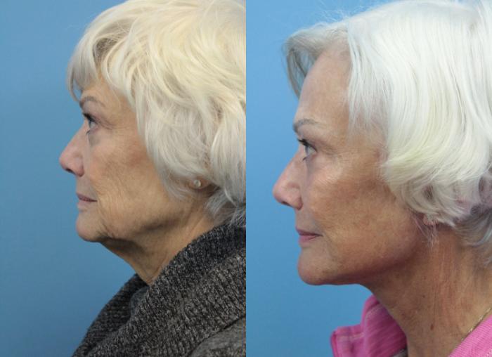 Before & After Facial Liposuction Case 339 Left Side View in West Des Moines & Ames, IA
