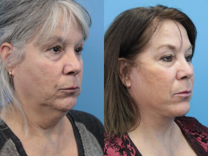 Before & After Facelift Case 344 Right Oblique View in West Des Moines & Ames, IA