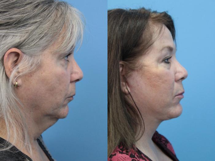 Before & After Facial Liposuction Case 344 Right Side View in West Des Moines & Ames, IA