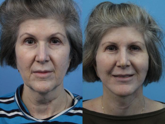 Before & After Facial Liposuction Case 350 Front View in West Des Moines & Ames, IA