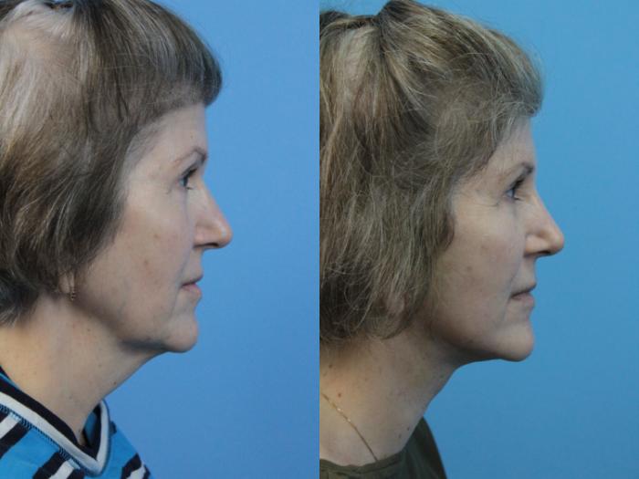 Before & After Facial Liposuction Case 350 Right Side View in West Des Moines & Ames, IA