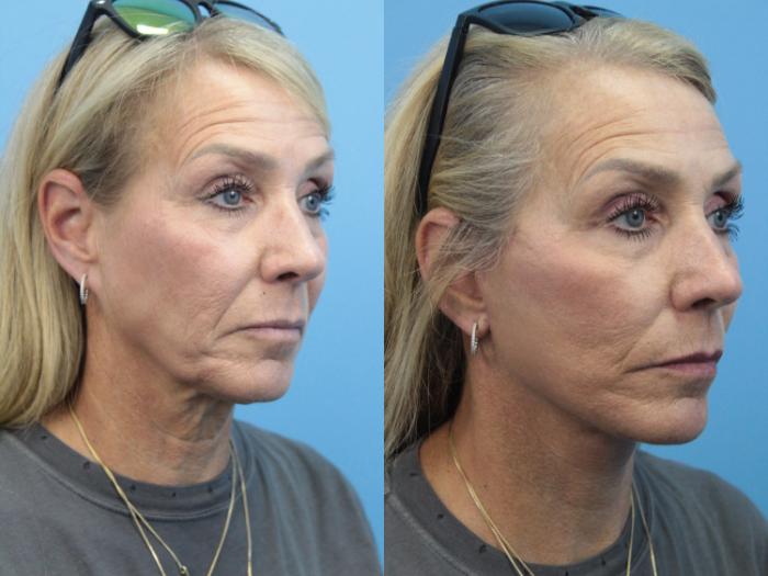 Before & After Facelift Case 358 Right Oblique View in West Des Moines & Ames, IA