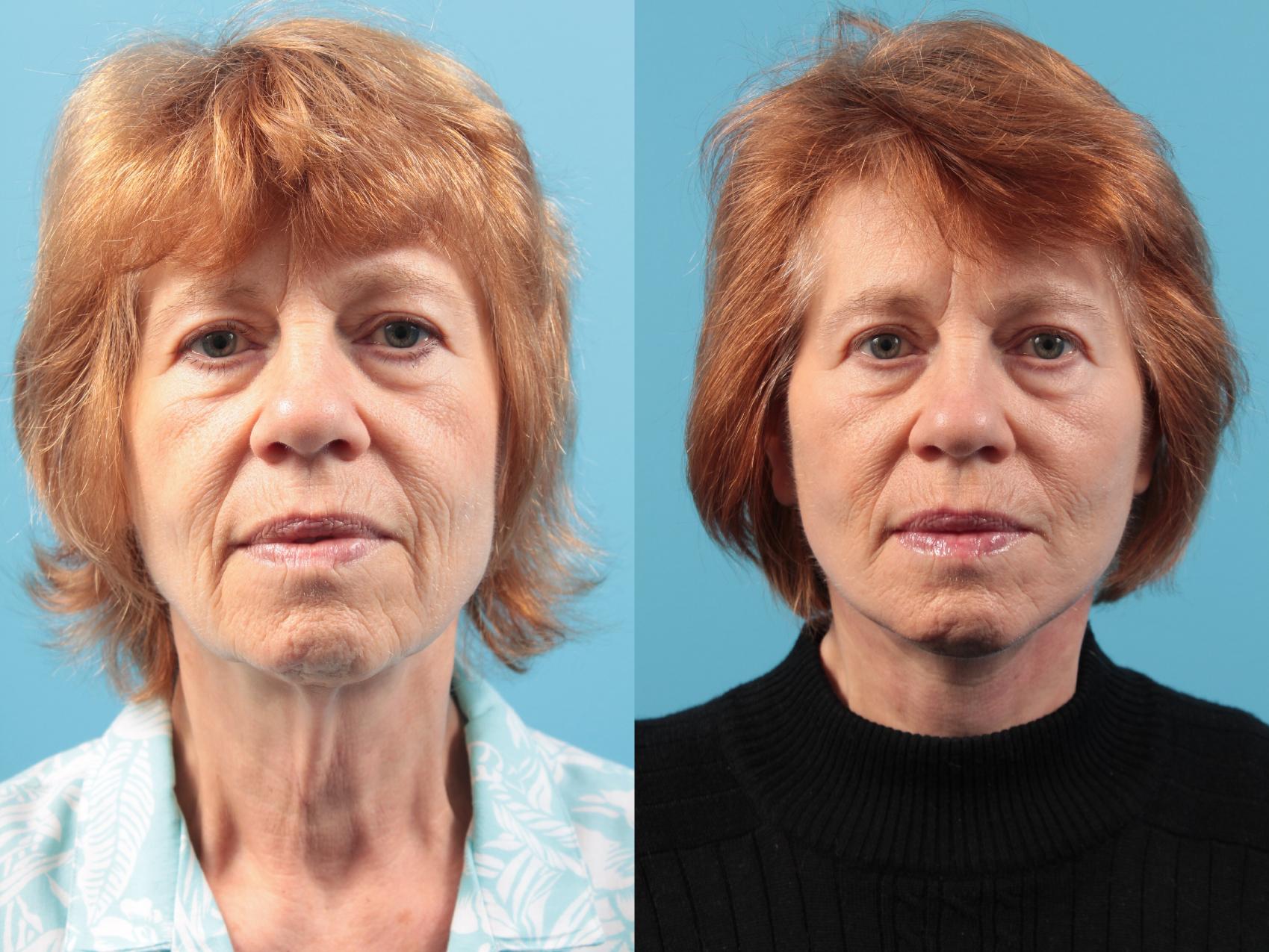 Before & After Blepharoplasty (Upper Eyelid Lift) Case 36 Front View in West Des Moines & Ames, IA