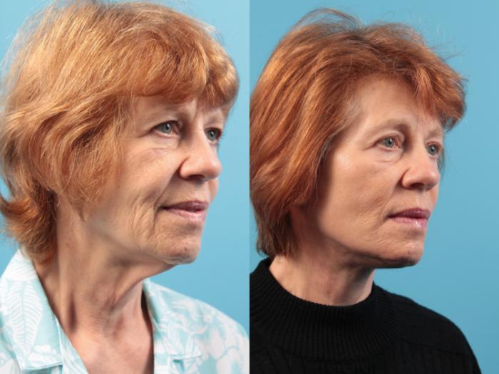 Before & After Facelift Case 36 Right Oblique View in West Des Moines & Ames, IA