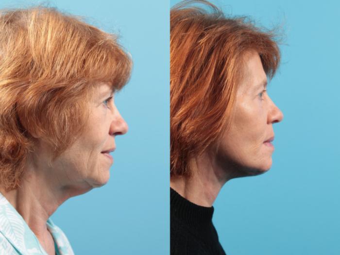 Before & After Facial Liposuction Case 36 Right Side View in West Des Moines & Ames, IA