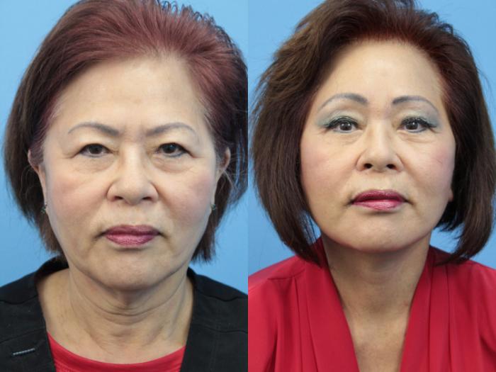 Before & After Brow Lift Case 365 Front View in West Des Moines & Ames, IA