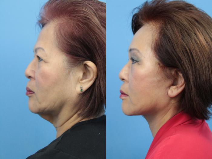 Before & After Brow Lift Case 365 Left Side View in West Des Moines & Ames, IA