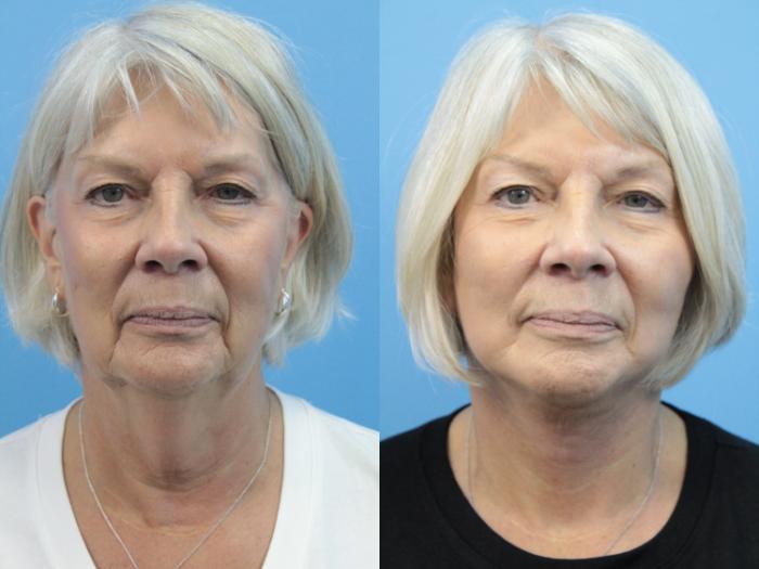 Before & After Facial Liposuction Case 366 Front View in West Des Moines & Ames, IA