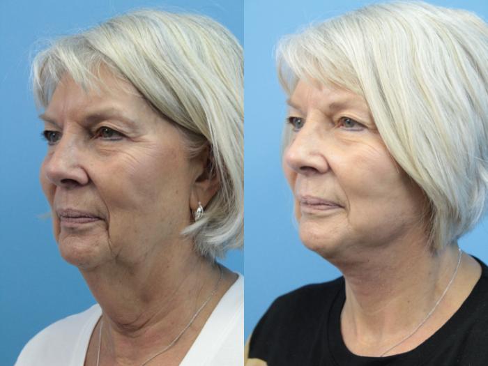 Before & After Facial Liposuction Case 366 Left Oblique View in West Des Moines & Ames, IA