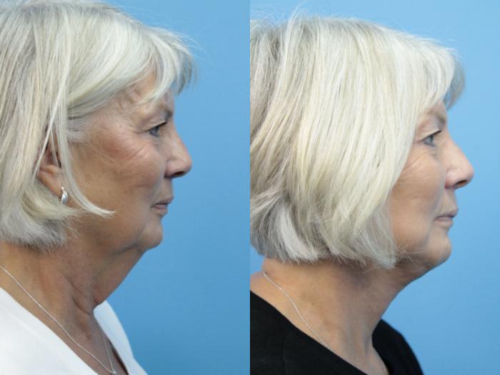 Before & After Facelift Case 366 Right Side View in West Des Moines & Ames, IA