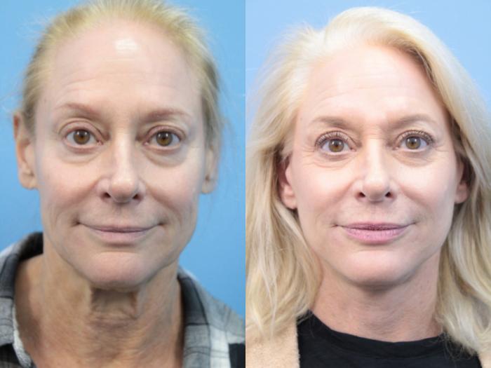 Before & After Facelift Case 374 Front View in West Des Moines & Ames, IA