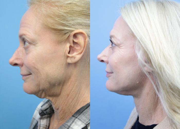 Before & After Facelift Case 374 Left Side View in West Des Moines & Ames, IA