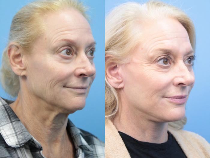Before & After Facelift Case 374 Right Oblique View in West Des Moines & Ames, IA