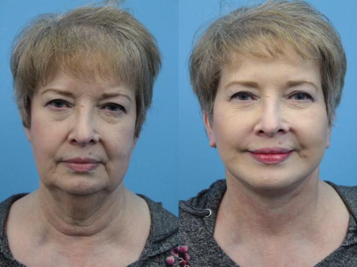 Before & After Facial Liposuction Case 383 Front View in West Des Moines & Ames, IA