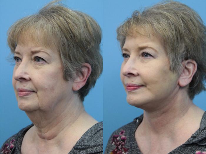 Before & After Facial Liposuction Case 383 Left Oblique View in West Des Moines & Ames, IA