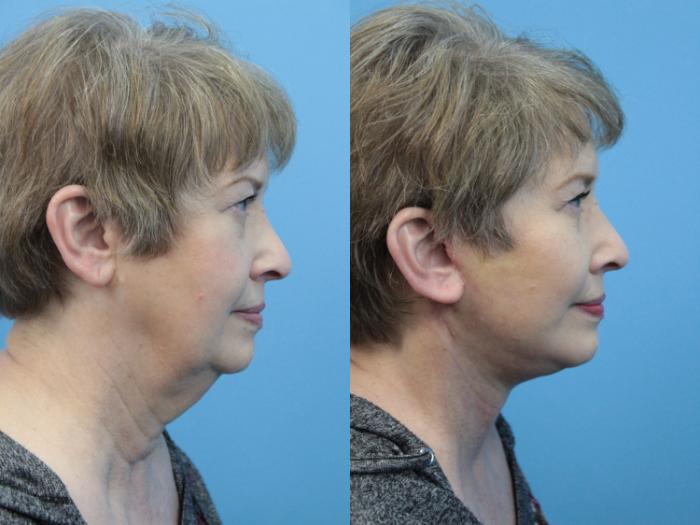 Before & After Facelift Case 383 Right Side View in West Des Moines & Ames, IA