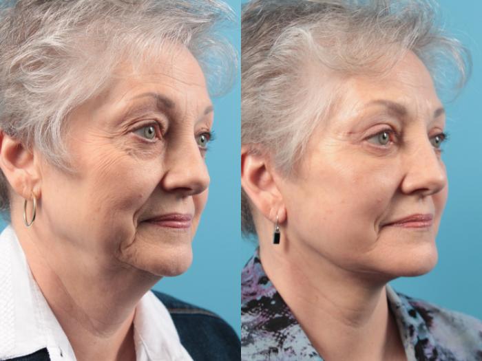 Before & After Facelift Case 39 View #1 View in West Des Moines & Ames, IA