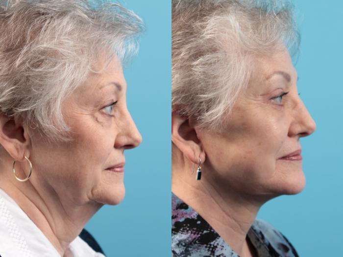 Before & After Facelift Case 39 View #2 View in West Des Moines & Ames, IA