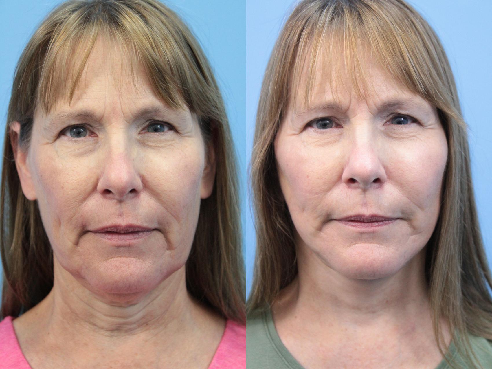 Before & After Facial Liposuction Case 395 Front View in West Des Moines & Ames, IA