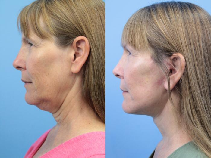 Before & After Facial Liposuction Case 395 Left Side View in West Des Moines & Ames, IA