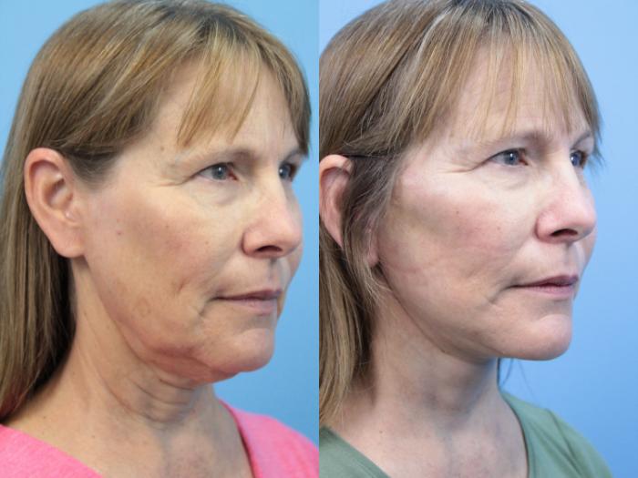 Before & After Facial Liposuction Case 395 Right Oblique View in West Des Moines & Ames, IA