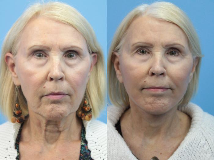 Before & After Facial Liposuction Case 396 Front View in West Des Moines & Ames, IA