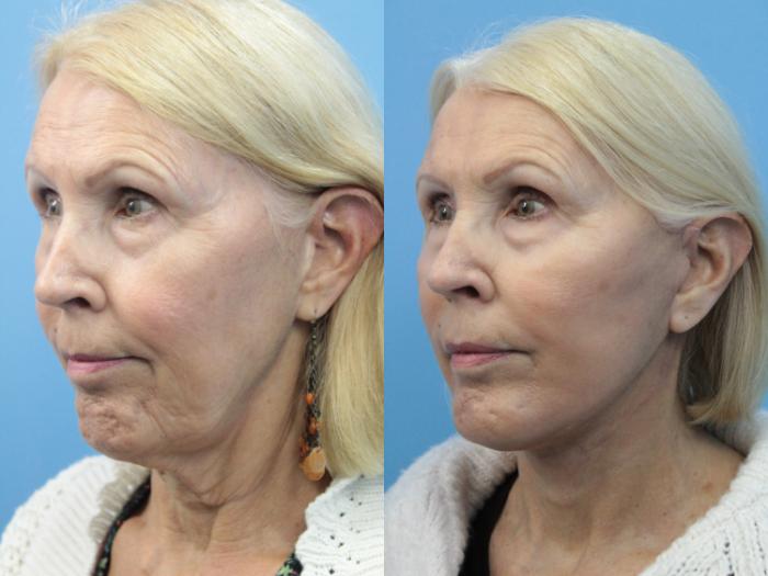 Before & After Facial Liposuction Case 396 Left Oblique View in West Des Moines & Ames, IA