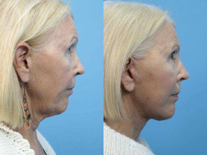Before & After Facelift Case 396 Right Side View in West Des Moines & Ames, IA