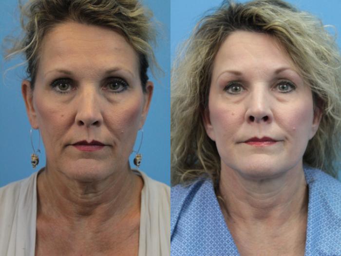 Before & After Facelift Case 397 Front View in West Des Moines & Ames, IA